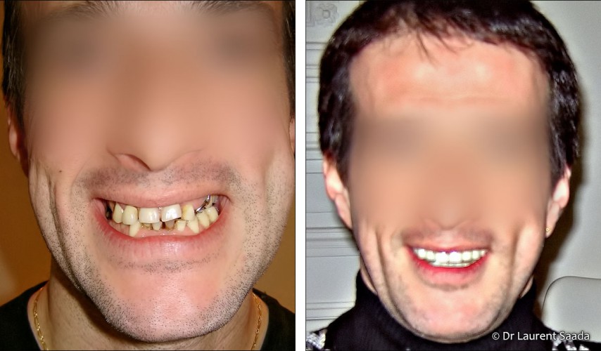 Dentisterie esthétique - Docteur Laurent SAADA, Chirurgien dentiste Paris