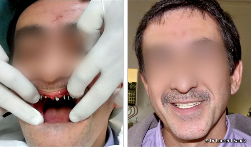 blanchiment dentaire - Docteur Laurent SAADA, Chirurgien dentiste Paris