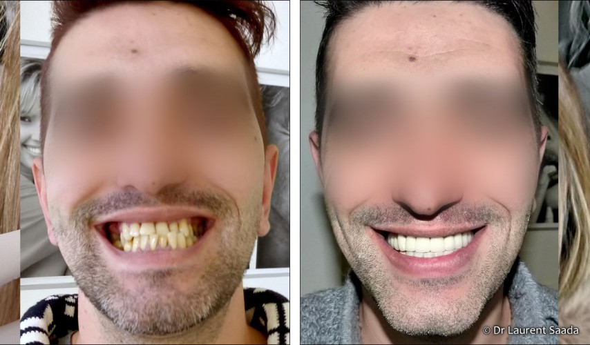 Dentisterie esthetique - Docteur Laurent SAADA, Chirurgien dentiste Paris