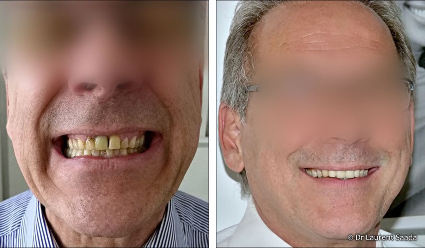 Dentisterie esthetique- Docteur Laurent SAADA, Chirurgien dentiste Paris