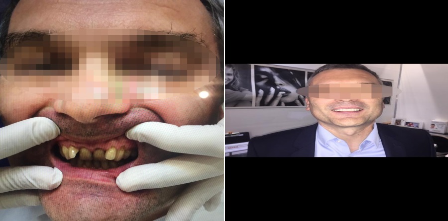 Implants dentaire - Docteur Laurent SAADA, Chirurgien dentiste Paris