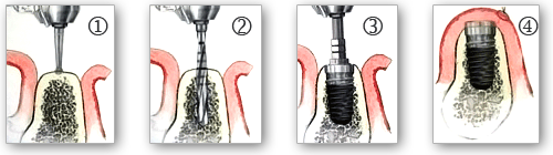 Implants dentaire - Docteur Laurent SAADA, Chirurgien dentiste Paris