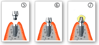 Implants dentaire - Docteur Laurent SAADA, Chirurgien dentiste Paris