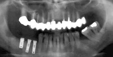 Implants dentaire - Docteur Laurent SAADA, Chirurgien dentiste Paris